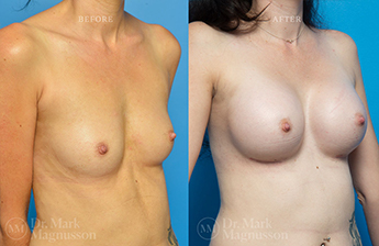 Dev Breast Problems - Chest Wall Deformity - 10