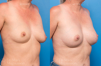 Dev Breast Problems - Polands Syndrome - 2