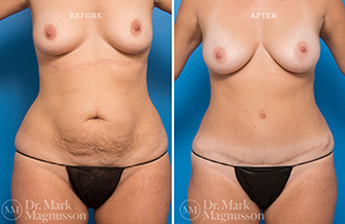 Liposuction - 360 LIPO - Normal Weight - 1