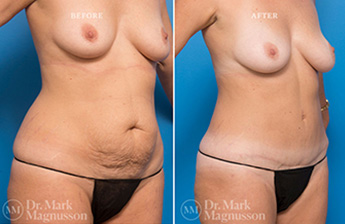 Liposuction - 360 LIPO - Normal Weight - 2
