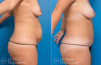 Liposuction - 360 LIPO - Normal Weight - 3