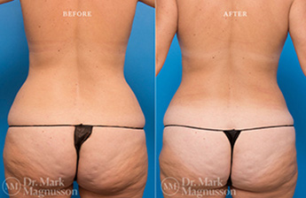 Liposuction - 360 LIPO - Normal Weight - 4
