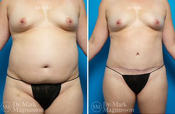 Liposuction – 360 LIPO – Obese - 1