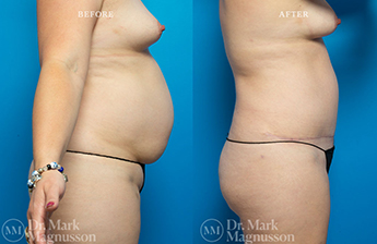 Liposuction – 360 LIPO – Obese - 2