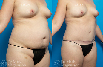 Liposuction – 360 LIPO – Obese - 3