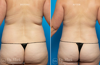 Liposuction – 360 LIPO – Obese - 4