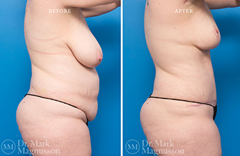 Liposuction – 360 LIPO – Obese - 5