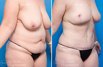Liposuction – 360 LIPO – Obese - 6