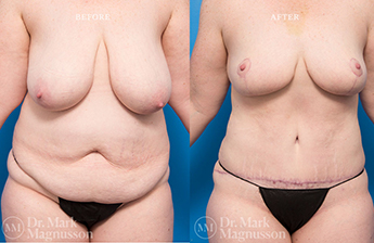 Liposuction – 360 LIPO – Obese - 7