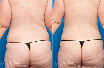 Liposuction – 360 LIPO – Obese - 8