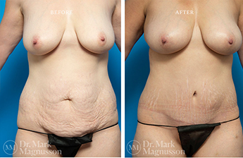 Liposuction – 360 LIPO – Overweight - 1
