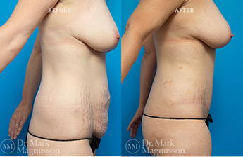 Liposuction – 360 LIPO – Overweight - 2