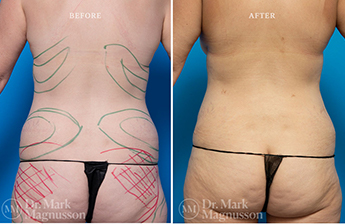 Liposuction – 360 LIPO – Overweight - 3