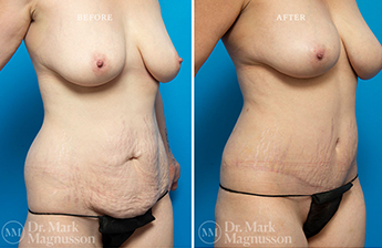 Liposuction – 360 LIPO – Overweight - 4