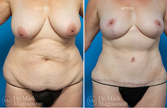 Liposuction – 360 LIPO – Overweight - 5