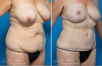 Liposuction – 360 LIPO – Overweight - 6