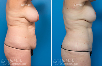 Liposuction – 360 LIPO – Overweight - 7