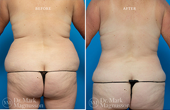 Liposuction – 360 LIPO – Overweight - 8