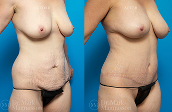 Massive Weight Loss - Normal Weight - 3