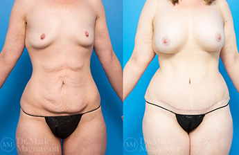 Massive Weight Loss - Normal Weight - 5