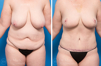 Massive Weight Loss - Obese - 1