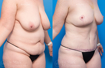 Massive Weight Loss - Obese - 2