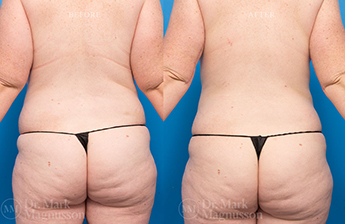 Massive Weight Loss - Obese - 3