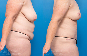 Massive Weight Loss - Obese - 4