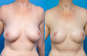 Mastopexy - Normal Weight - 1