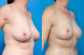Mastopexy - Normal Weight - 2