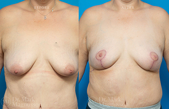 Mastopexy - Overweight - 1
