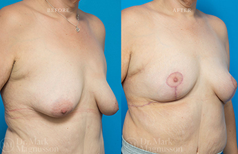 Mastopexy - Overweight - 2