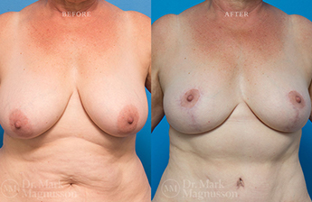 Mastopexy - Overweight - 3
