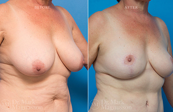 Mastopexy - Overweight - 4