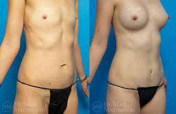 Mini Abdominoplasty - 1
