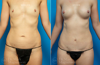Mini Abdominoplasty - 2