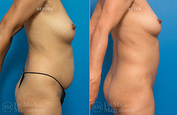 Mini Abdominoplasty - 3