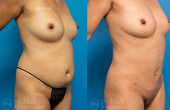 Mini Abdominoplasty - 4