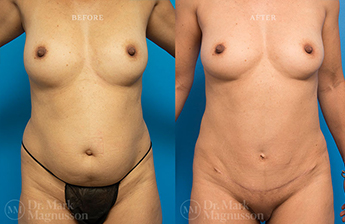 Mini Abdominoplasty - 5