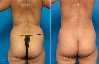 Mini Abdominoplasty - 6