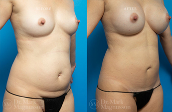 Mini Abdominoplasty - 8