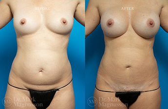 Mini Abdominoplasty - 9