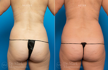 Mini Abdominoplasty - 10