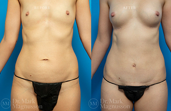 Mini Abdominoplasty and Breast Augmentation Gallery - 1
