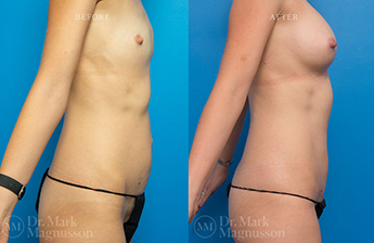 Mini Abdominoplasty and Breast Augmentation Gallery - 2