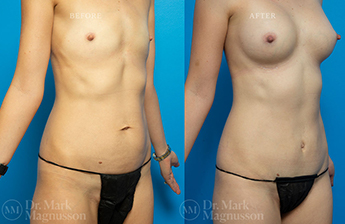 Mini Abdominoplasty and Breast Augmentation Gallery - 3
