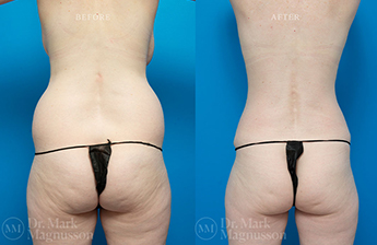 Abdominoplasty Bilateral Breast Reduction - Normal Weight - 6