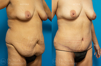Abdominoplasty - Overweight - 6