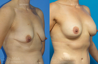 Breast Augmentation Mastopexy Gallery - 3
