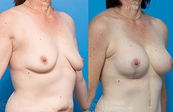 Breast Augmentation Mastopexy Gallery - 6
